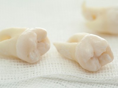 智齒疼了，這牙非拔不可嗎？