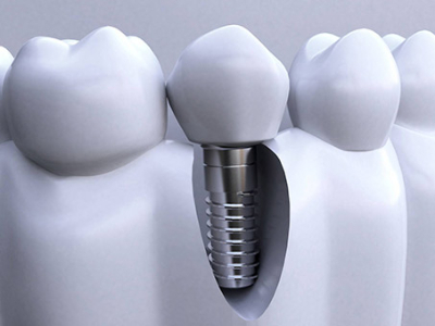 承德種植牙價(jià)格表，2024種植牙多少錢一顆呢?