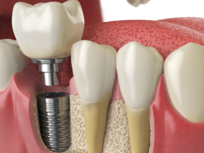 選擇種植牙后要做哪些日常維護？