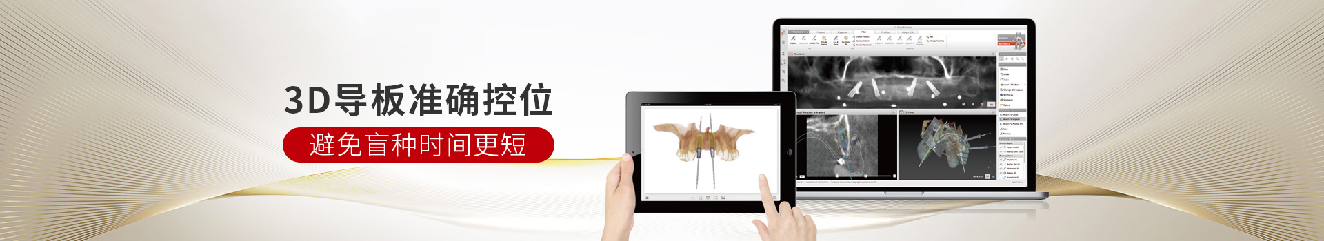 惟德口腔種植牙,3D導(dǎo)板準(zhǔn)確控位,避免盲種時(shí)間更短