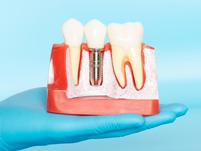 種牙VS鑲牙，你適合哪種?