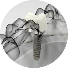 術(shù)前研究、模擬提升種植成功率