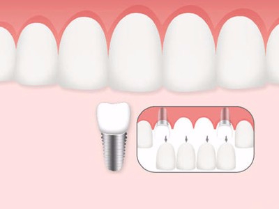 惟德口腔口腔種植怎么樣？惟德口腔就來(lái)為您一一解答