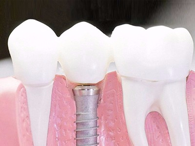 在承德口腔種植齒需要多少錢(qián)？惟德口腔一一為您道來(lái)